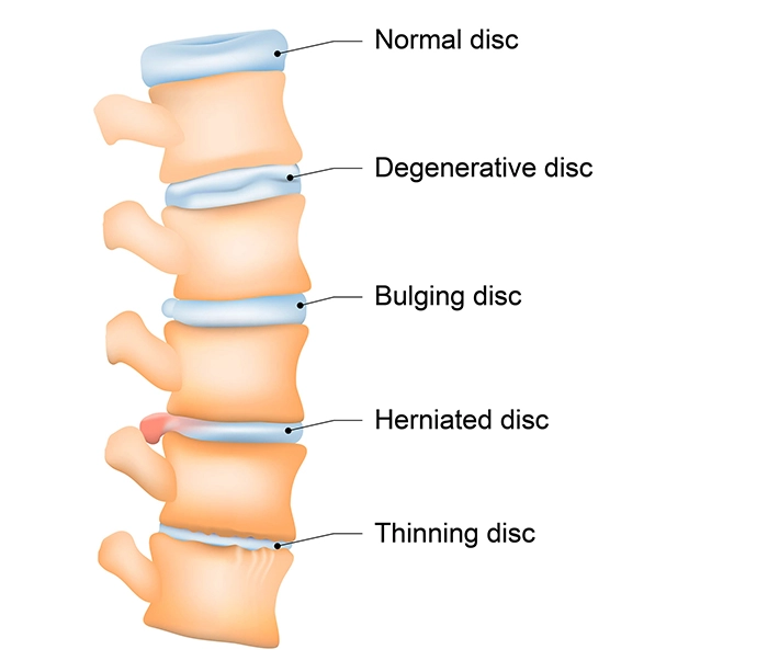 Spinal Decompression Pinnacle Chiropractic Highlands Ranch, CO