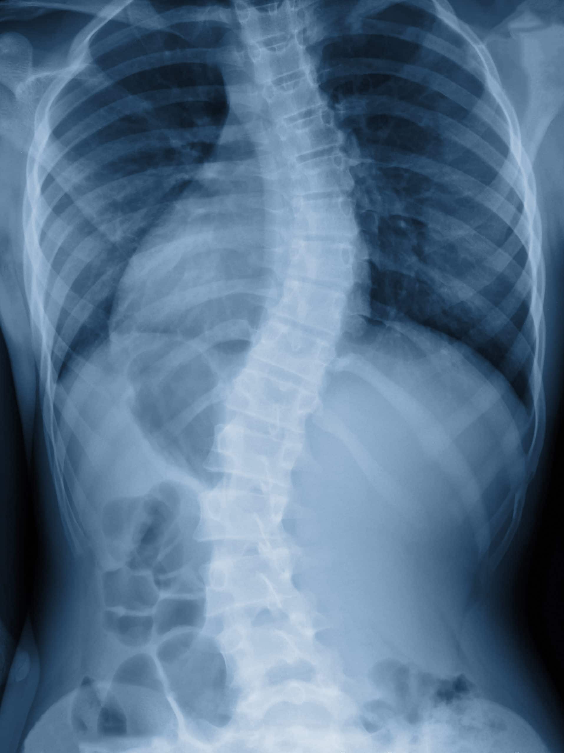 Pinnacle Chiropractic Highlands Ranch, CO scoliosis